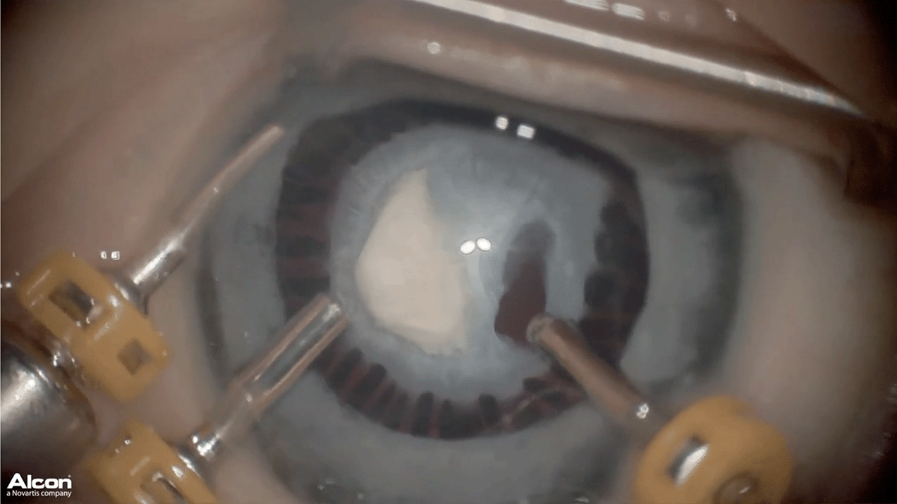 anterior-pfv-limbal.png