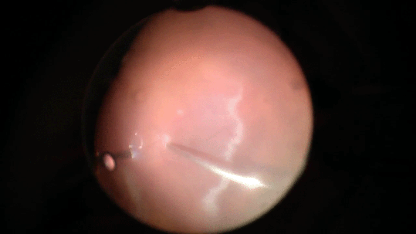 cmv-retinitis-rd-repair.png