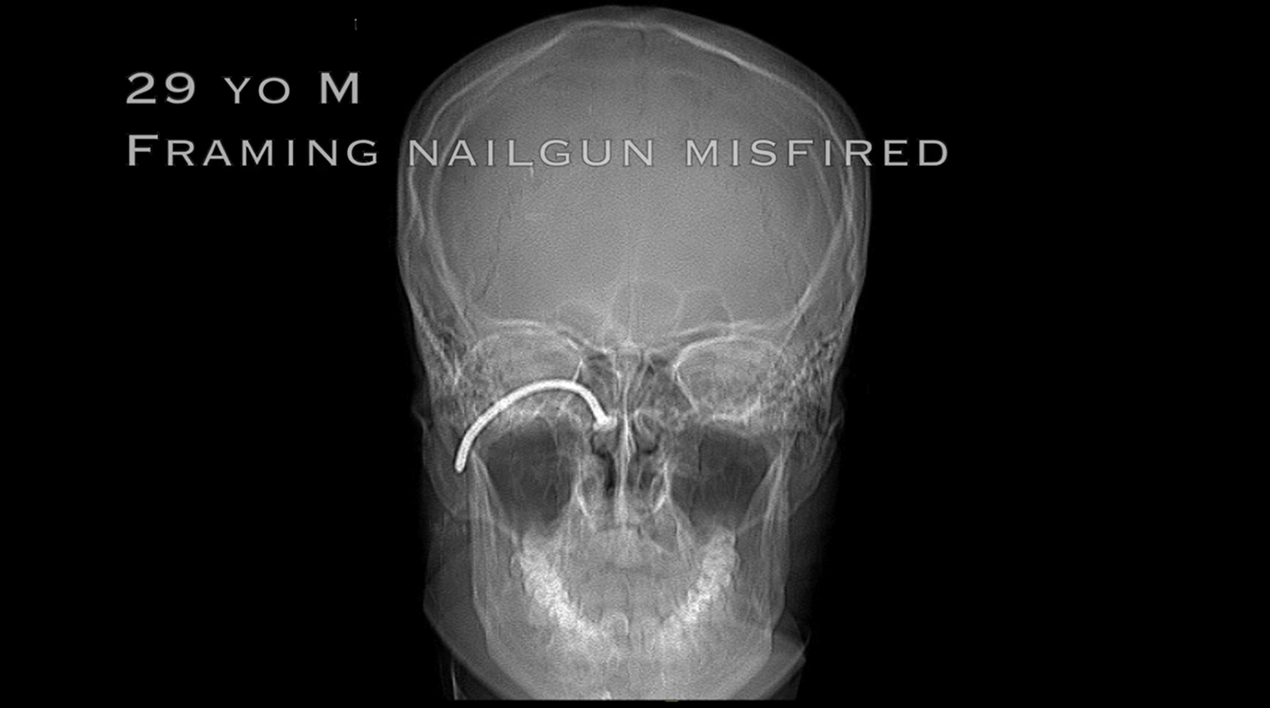 curved-nail-removal-and-ppv.png