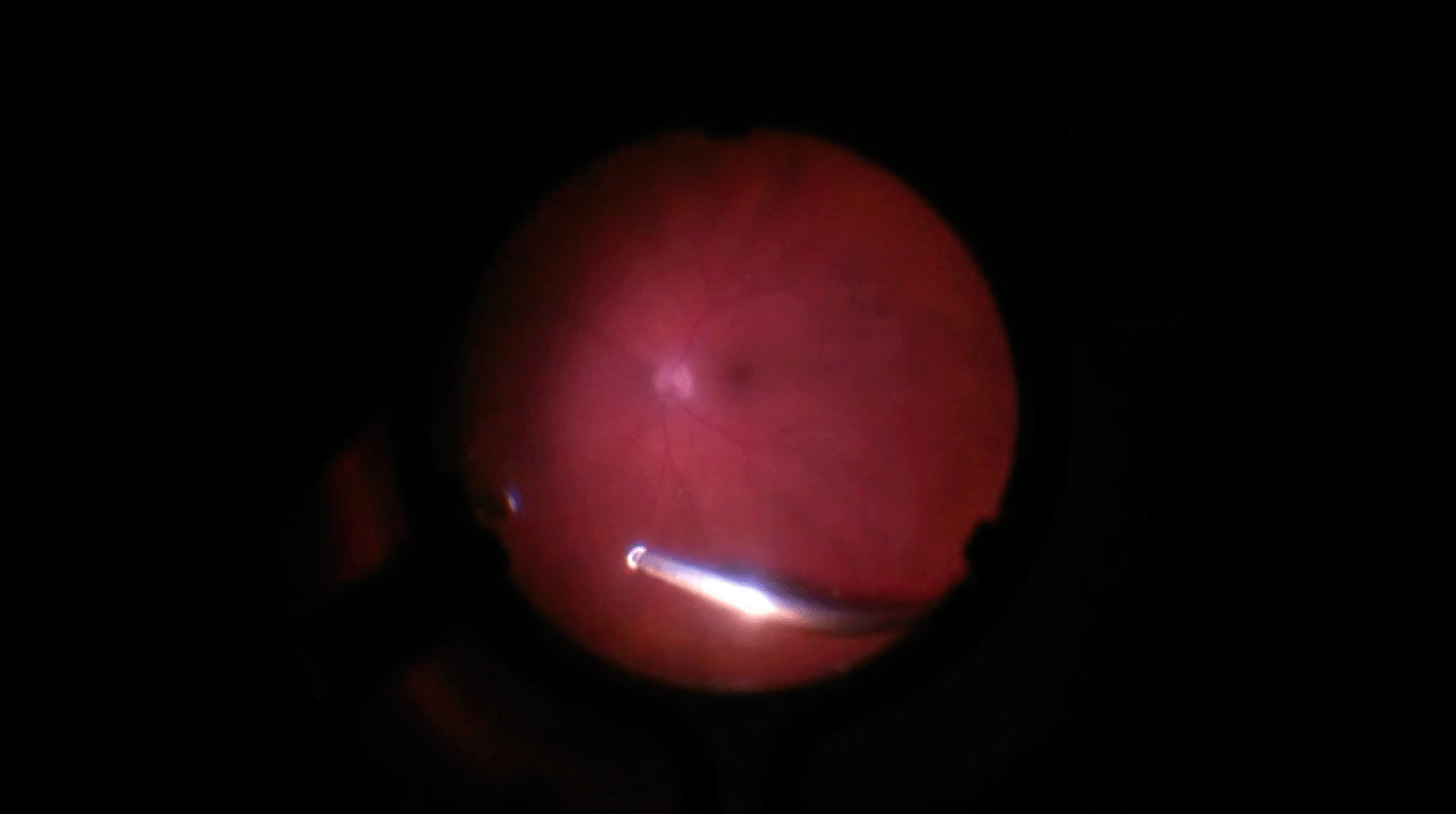 diagnostic-vitrectomy-for-lymphoma.png