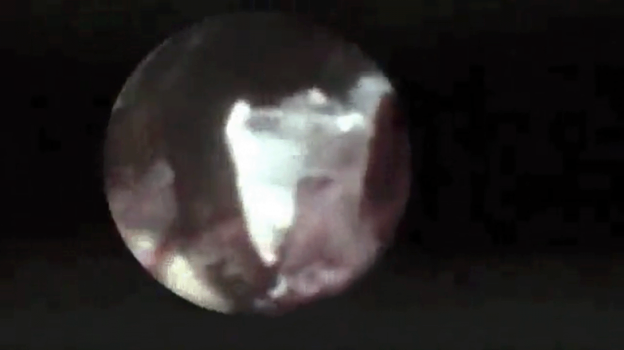 endoscopic-ppv-iofb.png