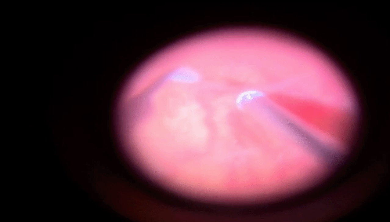 fevr-exudative-rd-hyaloid-peel.png