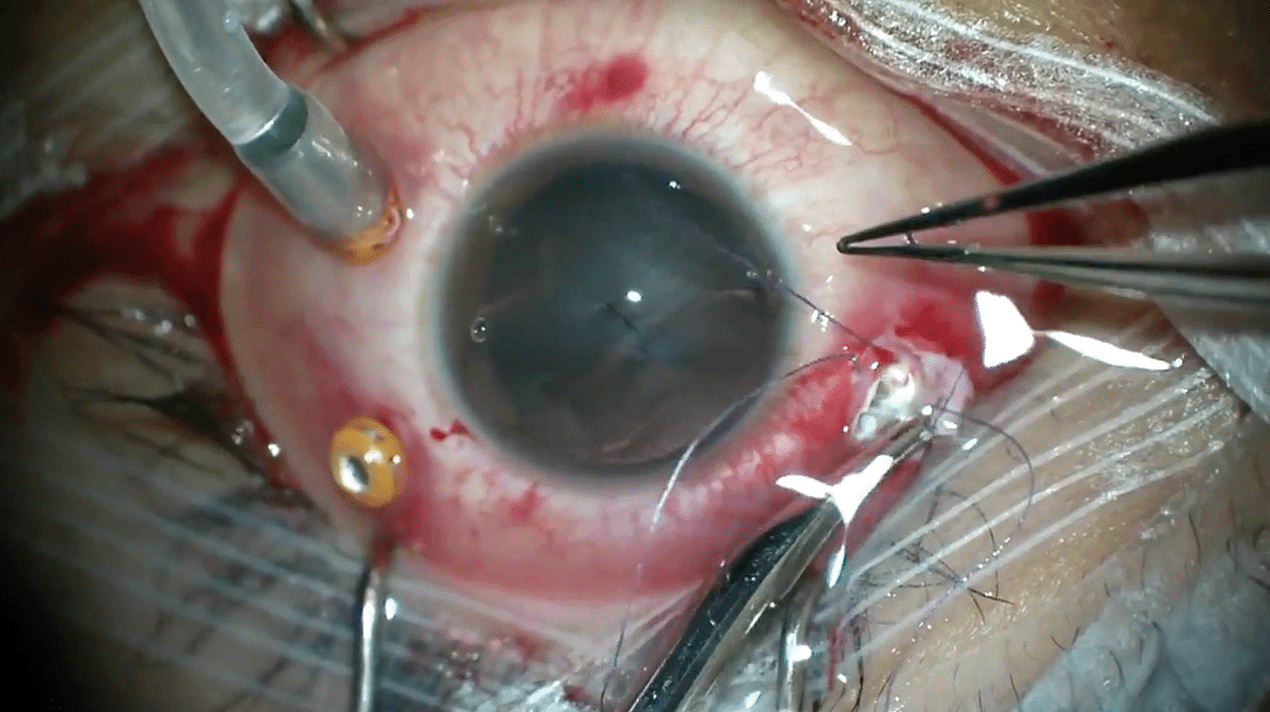 iofb-endophthalmitis.png