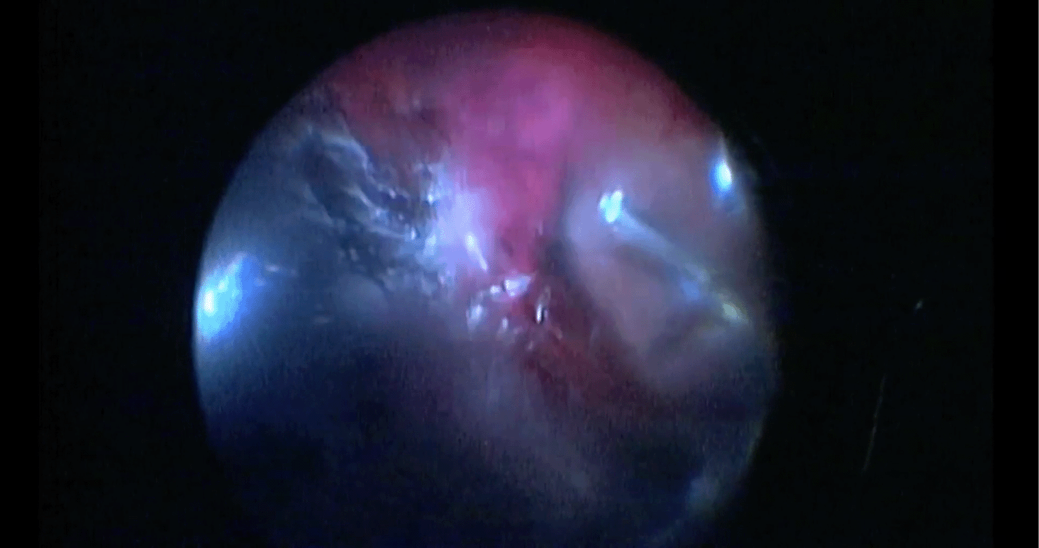 iofb-ppv-surgery.png