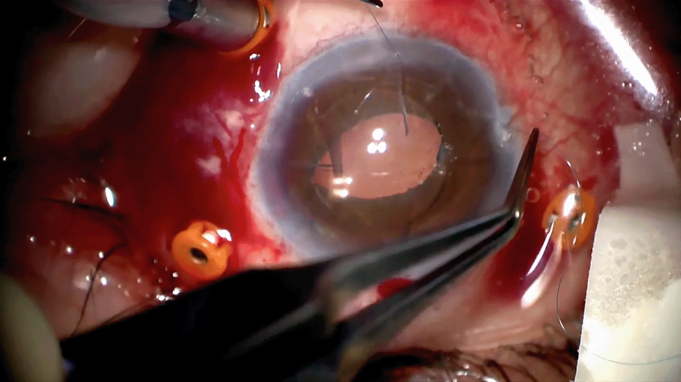 iris-sutured-iol.png