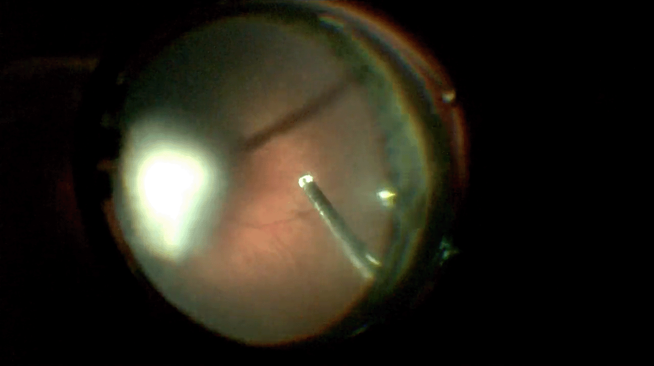 lens-sparing-ppv-for-pfv.png