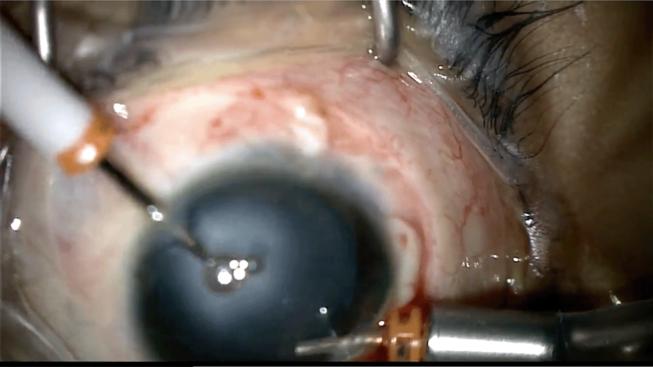 limbal-pfv-with-ppl.png