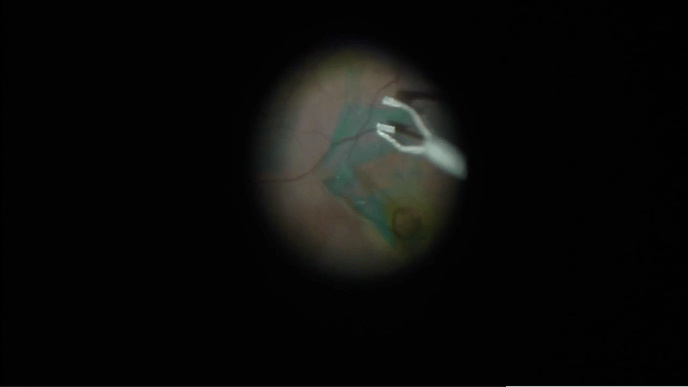 mh-ilm-flap.png