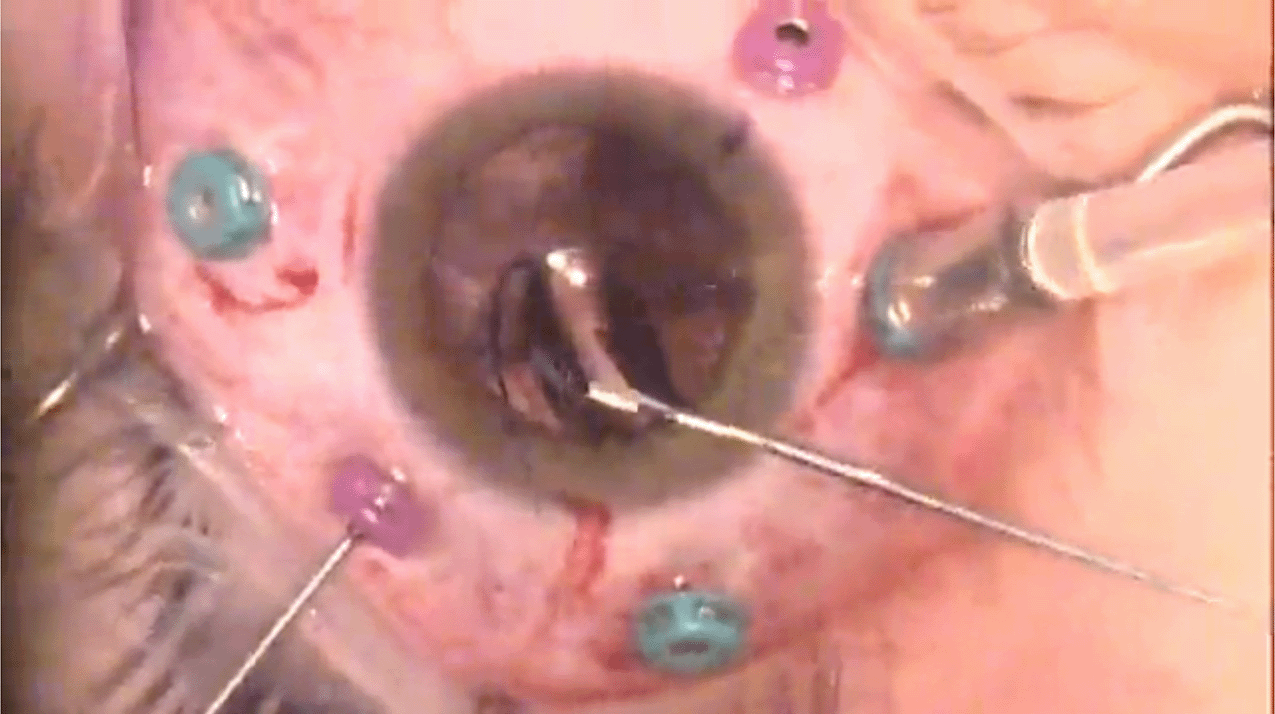 mkw-marfan-subluxed-lens.png