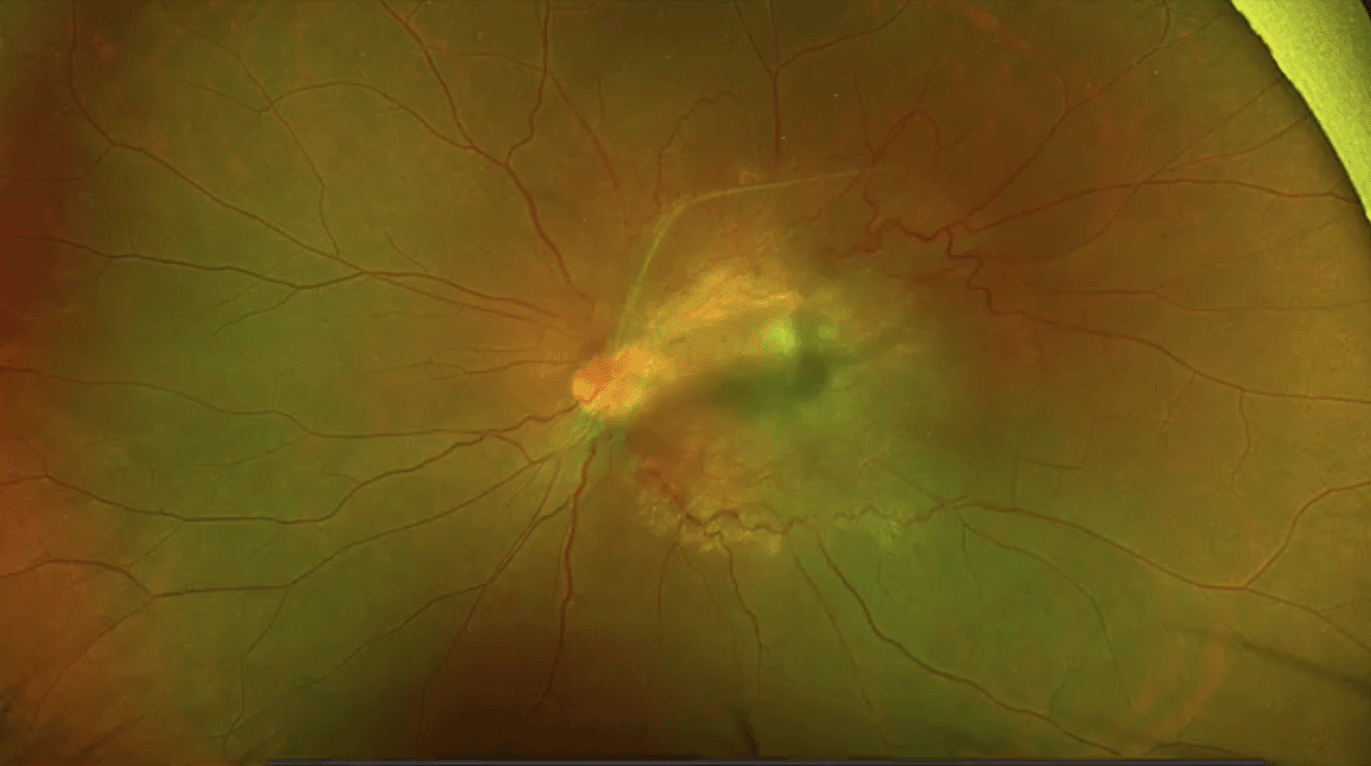 ocular-toxocariasis.png