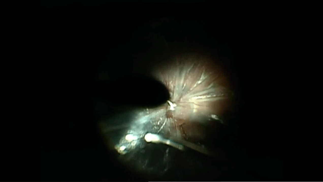 optic-nerve-coloboma-detachment.png
