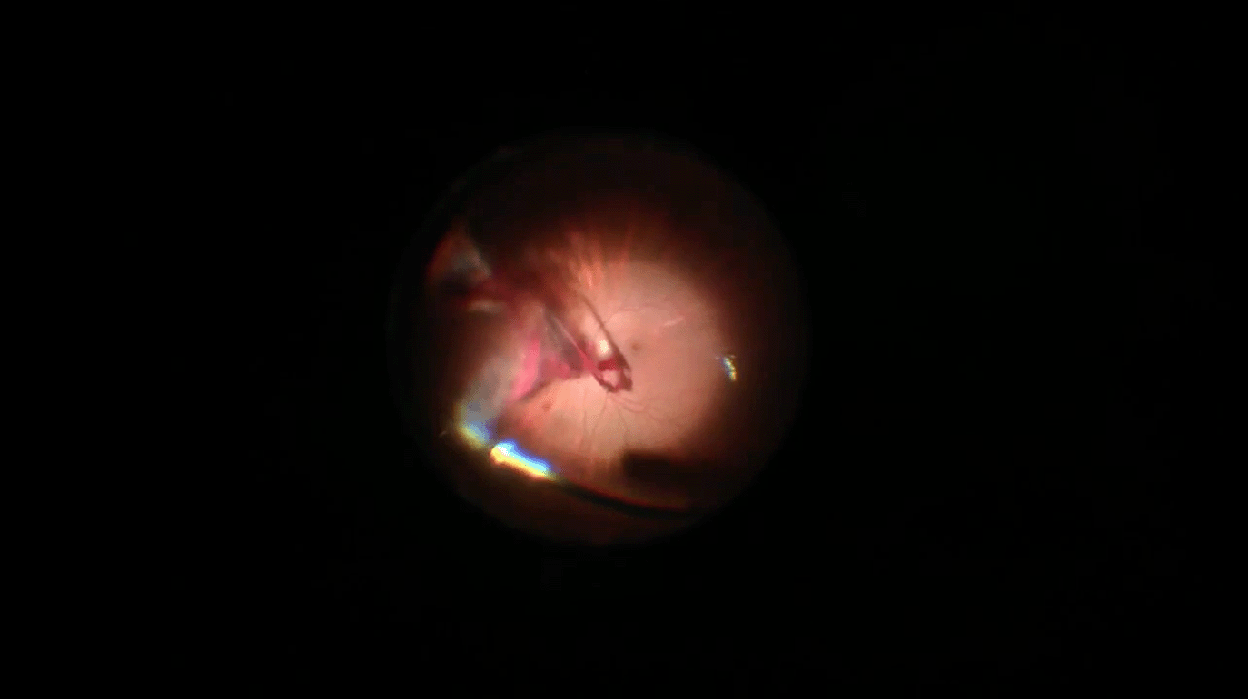 perforating-injury-after-bb-removal.png