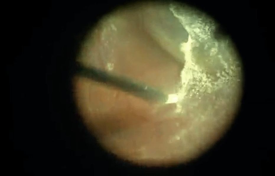 pick-then-sequential-pfo-tano-max-grip.png