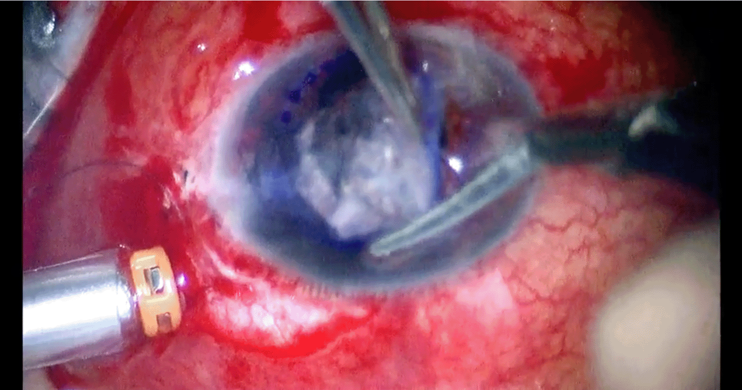 rd-and-corneal-opacity-after-ogr.png
