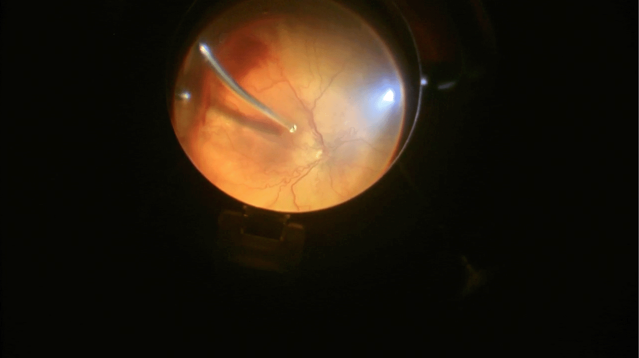 rop-4a-lens-sparing-ppv.png