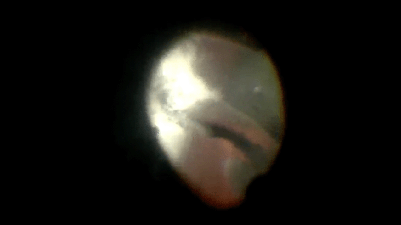 rop-stage4-lens-sparing-short-trocars-sutured-triamcinolone.png