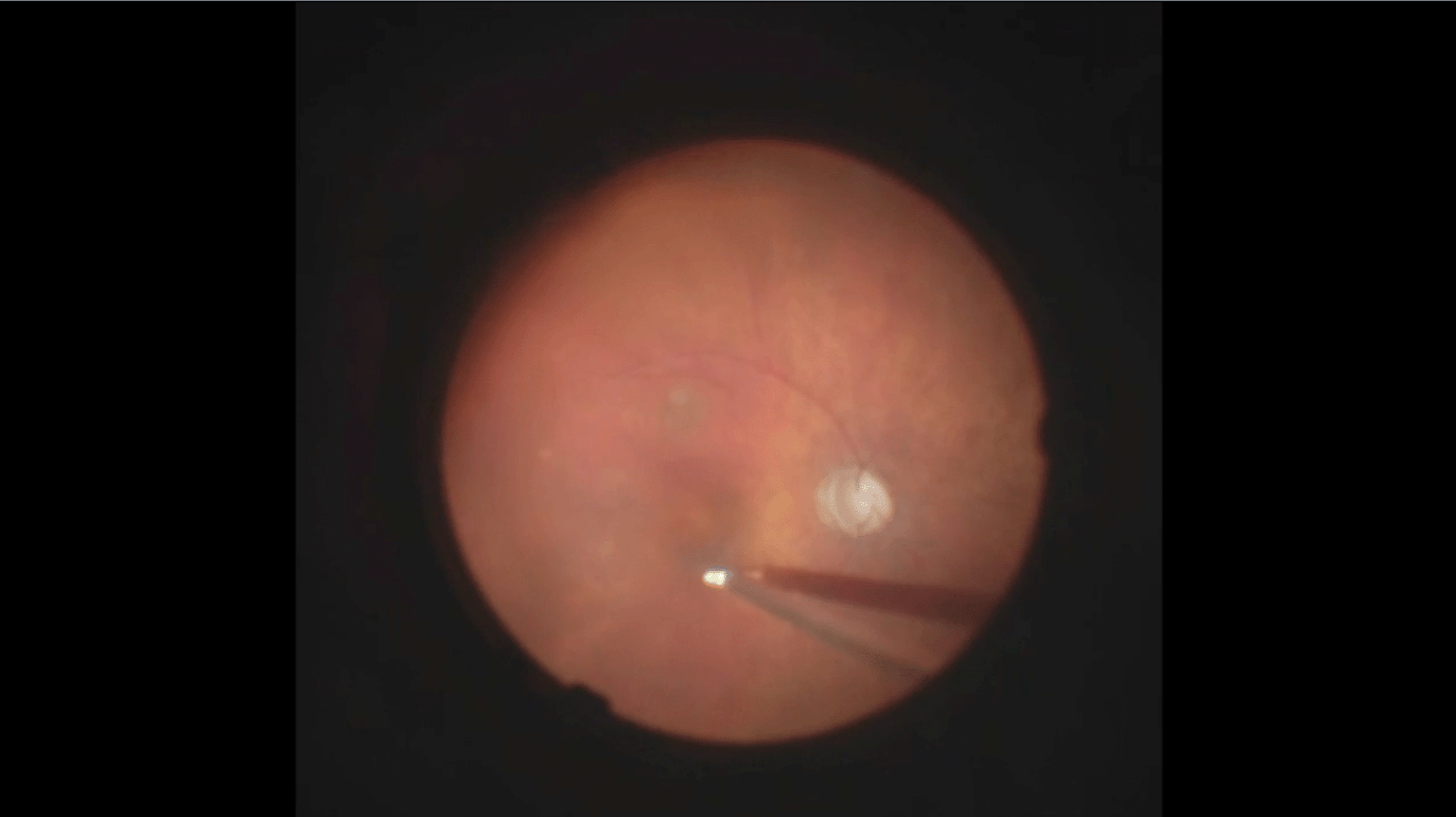 uveitis-ilm-peel-for-mh-repair.png