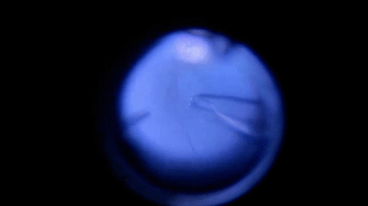 x-linked-retinoschisis-detachment.png